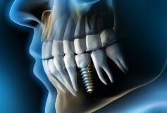 Ce trebuie sa stii despre implantul dentar